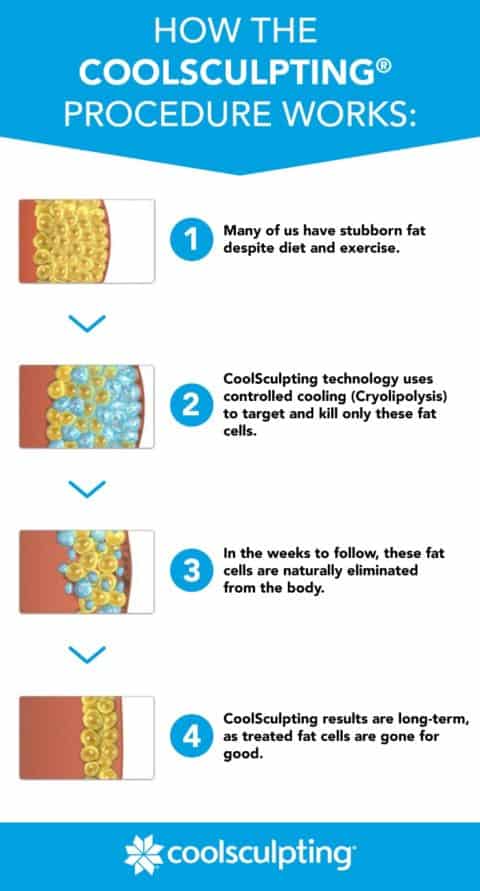 coolsculpting how it works